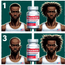 Use of finasteride in treating hair loss among athletes