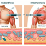 Subcutaneous vs intramuscular administration of trestolone acetato